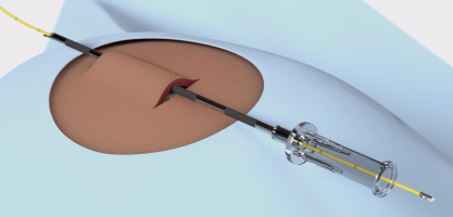 sensor_basic_implantation